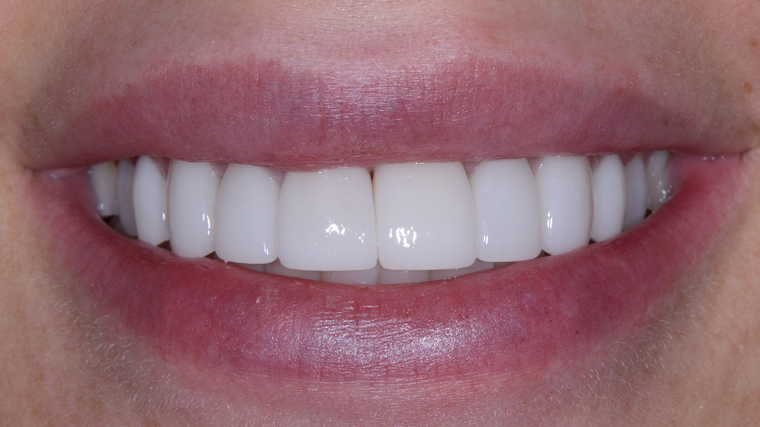 Everything You Need to Know About Porcelain Veneers